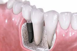 Dental Implants