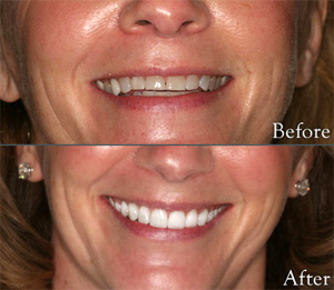 Porcelain Veneers